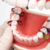 Стоматологическая матрица клиновые защитные секционные перегородки матричные зубы межзубный клин нож с защитой стальная матрица стоматология