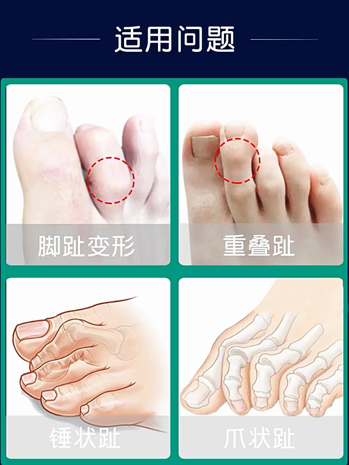 Toe Splint Straightener for Hammer Toe Straightener Curved Toe Claw Toe Stabilizer Support Bracket Children Adults