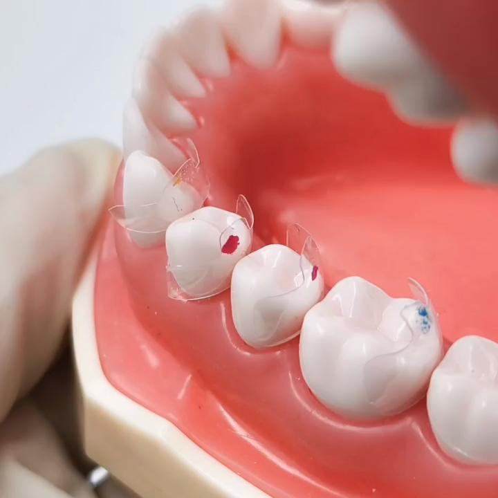 10 Pcs/ 20pcs/ 40 Pcs Dental Clear Matrix Bands Transparent Matrices Posterior Molar Composite Class Restorative 4.5/5.5/6.5/8.0 Fits Bioclear